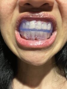 Click to view full screen Orthodontische Beugels voor het slapen photo review