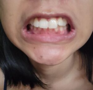 Click to view full screen Orthodontische Beugels voor het slapen photo review